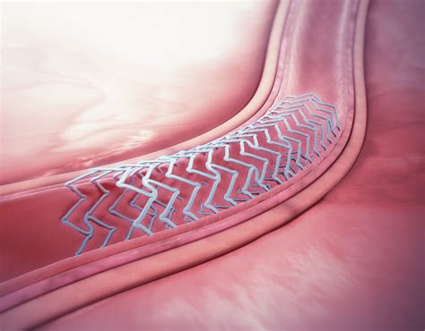 Bioresorbable materials boost medical devices - ASME