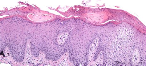 Figure 5.3.7 Spongiotic dermatitis. – Derm In-Review