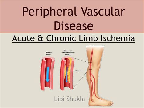 PPT - Peripheral Vascular Disease Acute & Chronic Limb Ischemia ...