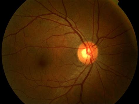 Normal Retinal Anatomy - The Retina Reference