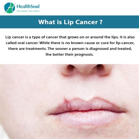 Early Signs Of Lip Cancer Images | Hot Sex Picture