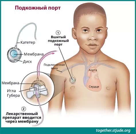 Подкожная порт-система | Ezgu Amal