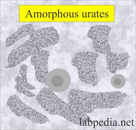 Amorphous Urates In Urine