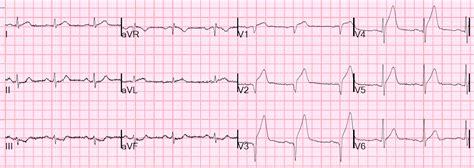 Anterior STEMI EKG