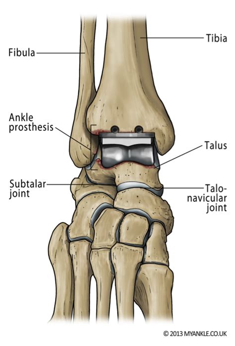 London ankle replacement - ankle replacement - my ankle