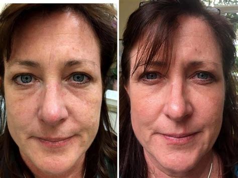 Vampire Facelift Before And After Pics (1) » Facelift: Info, Prices, Photos, Reviews, Q&A