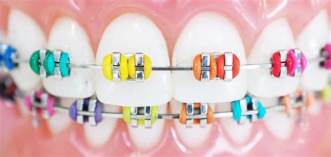 Types of Braces | Santa Clarita, California | Kidz Dental Care SCV and PR