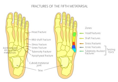 There are different types of foot fractures, learn how to identify each