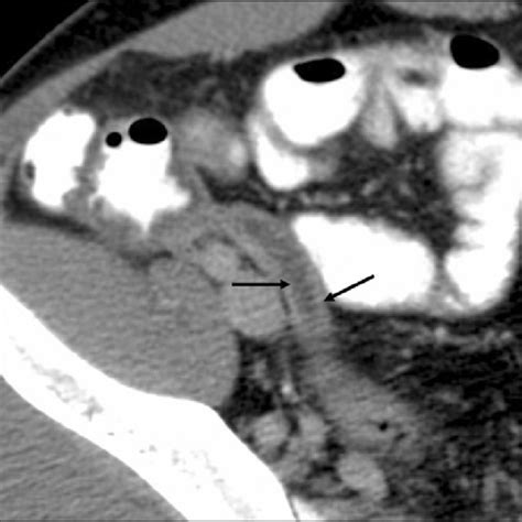 year-old man with acute appendicitis. Oral and IV contrast-enhanced CT ...