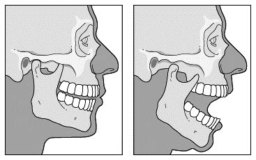 Trick of the Trade: Temperomandibular (TMJ) dislocation