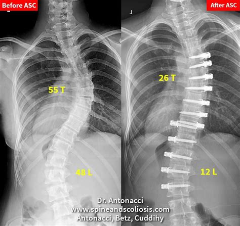 SP 12 Scoliosis Double Curve from 55 Thoracic - Institute for Spine and ...