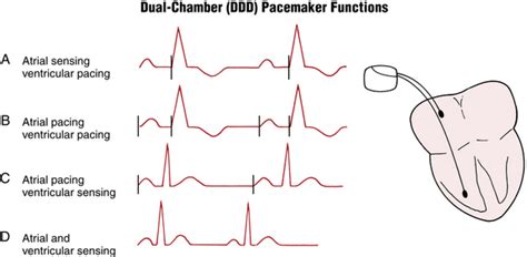 Pacemaker Sensing