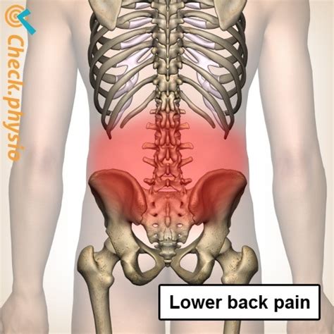 Nonspecific lower back pain | Physio Check