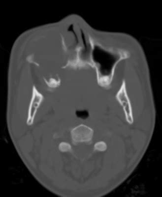 Maxillary SInus Mucocele-CT - Sumer's Radiology Blog