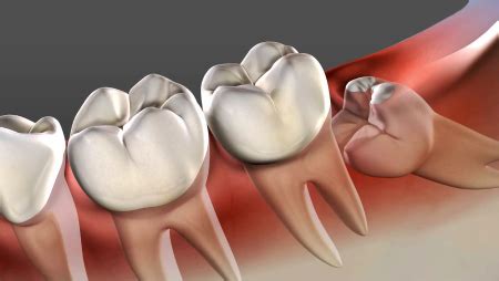 Impacted Tooth Exposure Salt Lake City UT | Third Molar