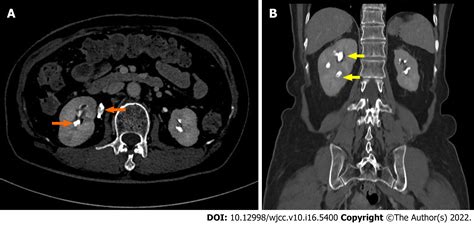 Renal papillary necrosis with urinary tract obstruction: A case report