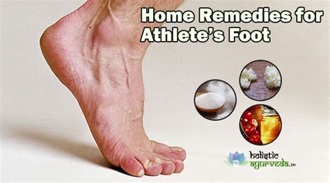 9 Home Remedies for Athlete's Foot, Cure with Natural Treatment