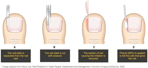 Infected Ingrown Toenail, Nail Fungus - Infected Toe Treatment Near You — Fitzroy Foot and Ankle ...