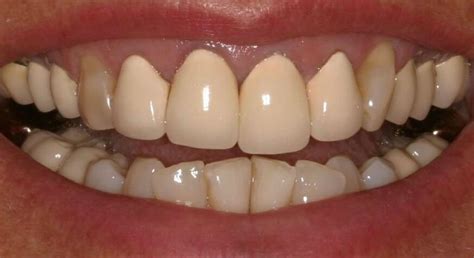 Porcelain Crowns | Dr. Susan Dennis | Kalamzoo MI