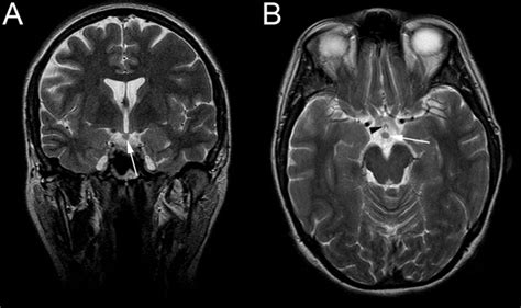 Hypothalamic hamartoma | BMJ Case Reports