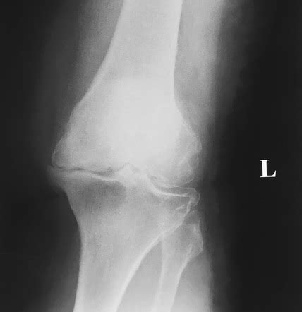 Osteoarthritis of the knee | Radiology Reference Article | Radiopaedia.org