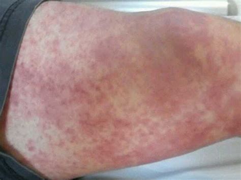 Image of the Week: Macular Rash on Both Legs - Clinical Advisor