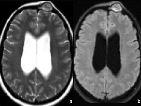 MRI demonstrated T2 (a) hyperintensity and contrast enhancement on ...