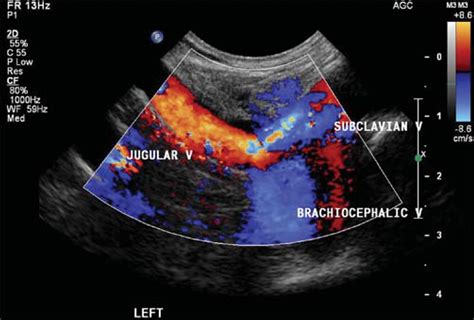 Reversed internal jugular vein flow as a sign of brachiocephalic vein ...