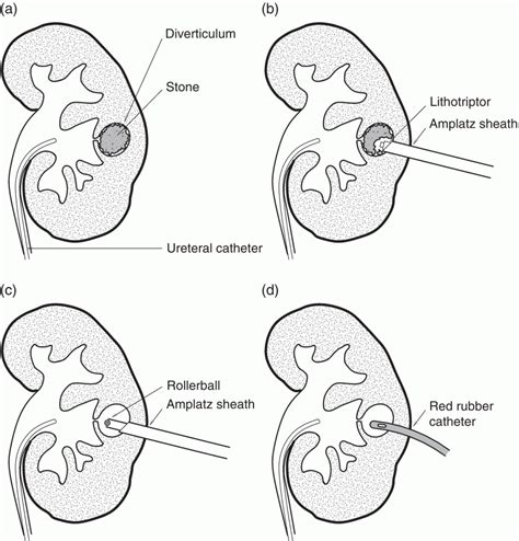 Percutaneous Nephrolithotomy of Calyceal Diverticula, Infundibular ...