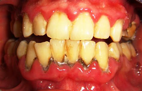 Symptoms of Gum Disease | CleverTopic