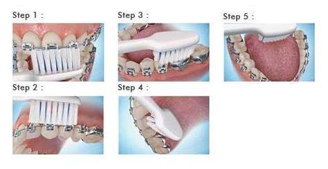 Dentist Gainesville VA | Brushing with Braces