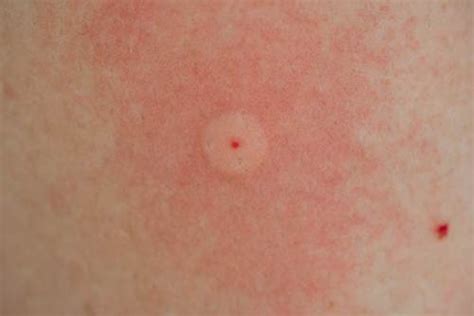 How to Treat Brown Recluse Spider Bite? (And, Prevention Tips)