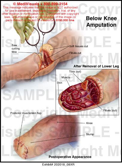 Below Knee Amputation Medical Illustration Medivisuals