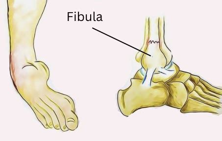 Fibula Fractures - Cumberland Physiotherapy Sport & Rehabilitation