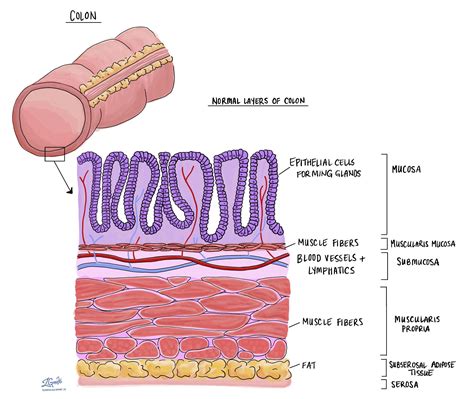 Tubular adenom i tjocktarmen | Hi-Tech