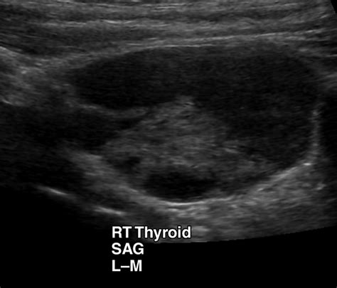 Cystic Parathyroid Adenoma: Sonographic Features and Correlation With 99mTc-Sestamibi SPECT ...