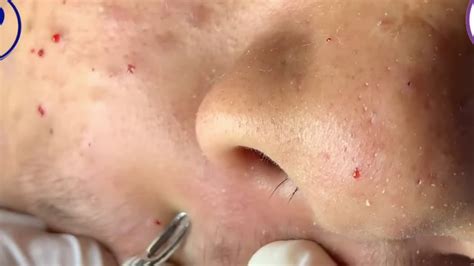 TOP (BLACKHEADS REMOVAL} - YouTube