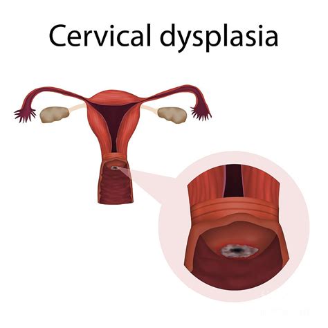 Cervical Dysplasia Photograph by Veronika Zakharova/science Photo Library