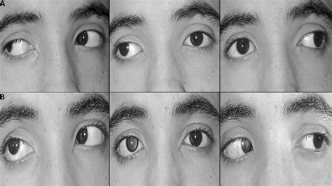 Early Recurrence for Intermittent Exotropia After Surgery High