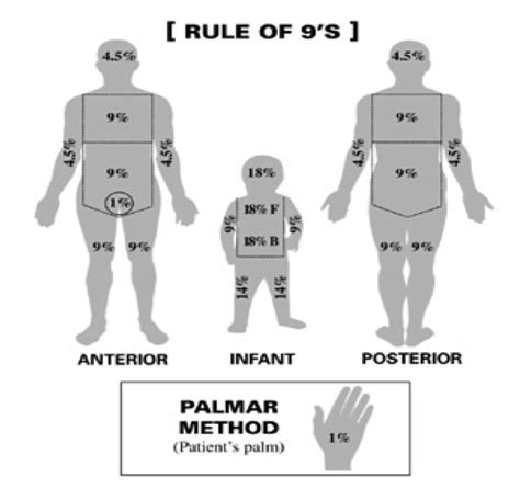 Rule Of Nines Burn Chart Children - Ponasa