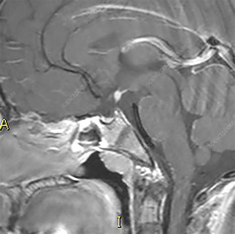 Small Pituitary and Ectopic Neurohypophysis, MRI - Stock Image - C030/6452 - Science Photo Library