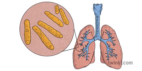 Tuberculosis Bacteria Illustration - Twinkl