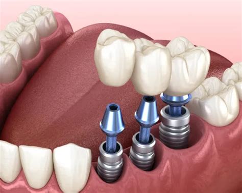 dental implants near me