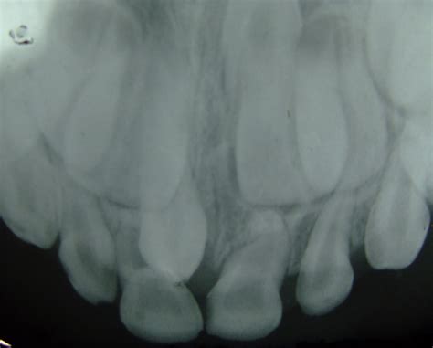 Hyperdontia X Ray