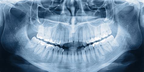 Radiographie dentaire à Obernai | Imagerie Médicale du Piémont