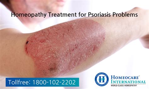 Homeopathy Treatment for Psoriasis problems | Homeocare International