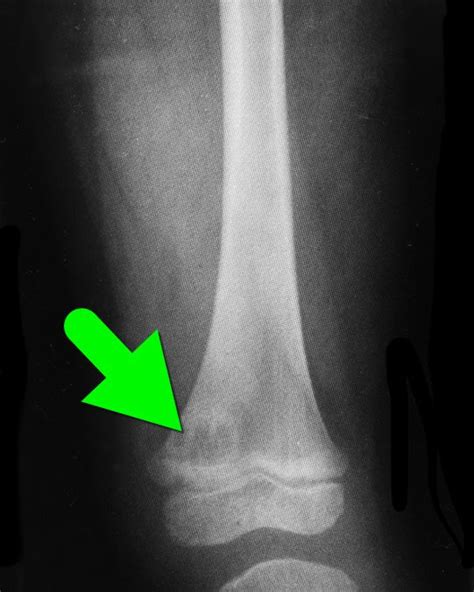 Brodie's abscess a.k.a subacute osteomyelitis Form of osteomyelitis, which is difficult to ...