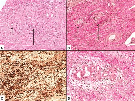 IgG4-related sclerosing cholangitis mimicking hilar cholangiocarcinoma (Klatskin tumor): a case ...