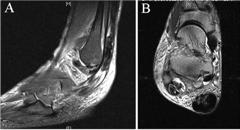 Figure 1 from Allograft Reconstruction of Peroneal Tendons | Semantic Scholar