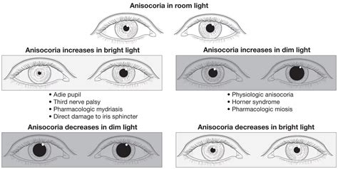 Anisocoria Symptoms, Diagnosis, Treatment - Rxharun